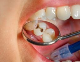 protéger ses dents contre les caries