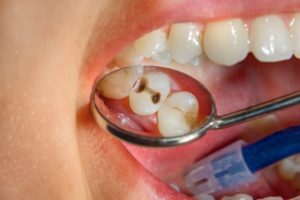 protéger ses dents contre les caries