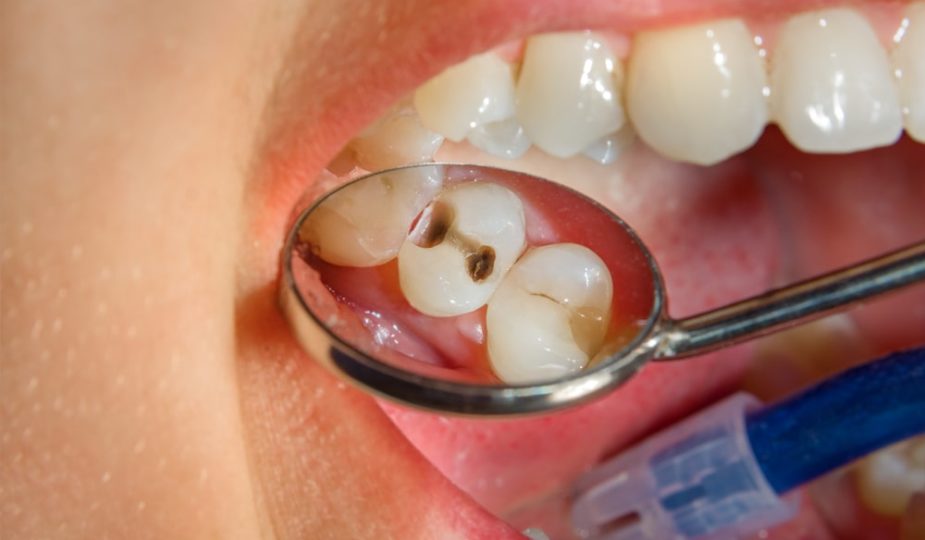 protéger ses dents contre les caries