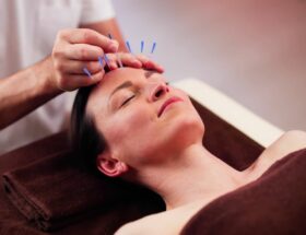 acupuncture