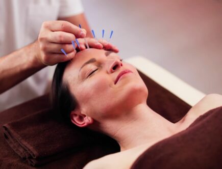 acupuncture